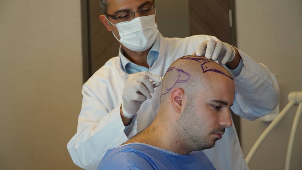 Istanbul: The Mecca of Hair Transplants