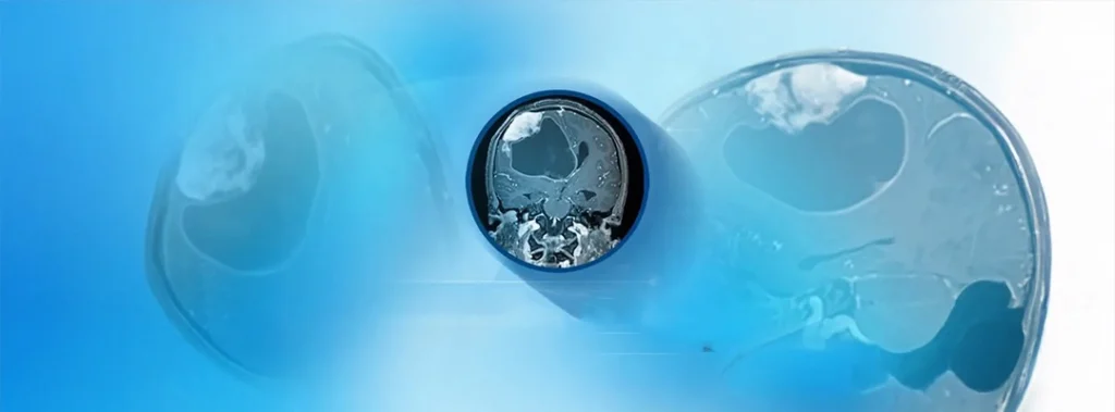 Brain Tumors in Children: Types, Causes, Symptoms & Treatment