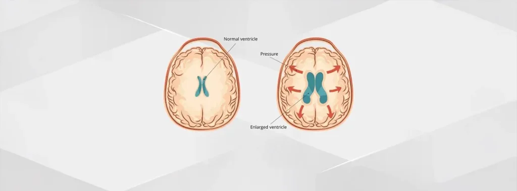 Endoscopic Third Ventriculostomy for Hydrocephalus