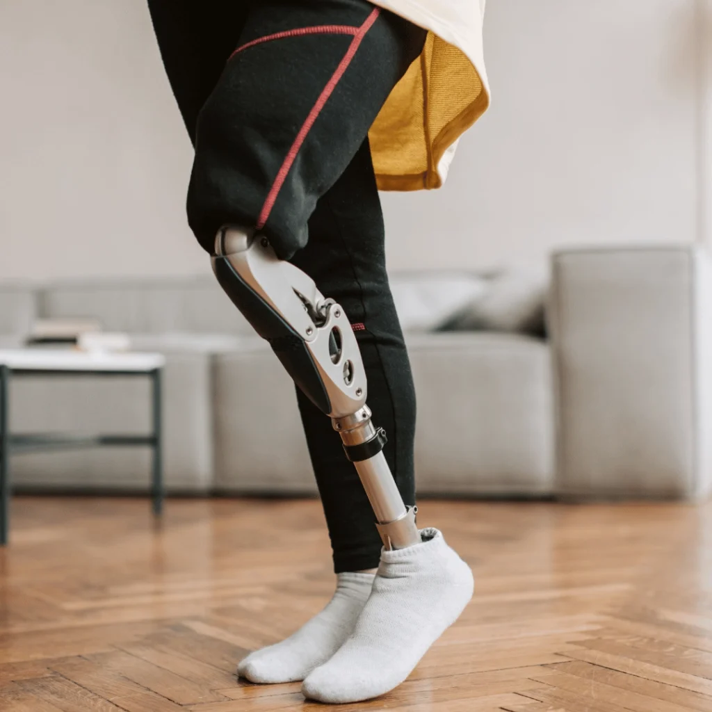 Prosthetic Disc Nucleus (PDN): What is a Prosthetic Disc Nucleus (PDN)?