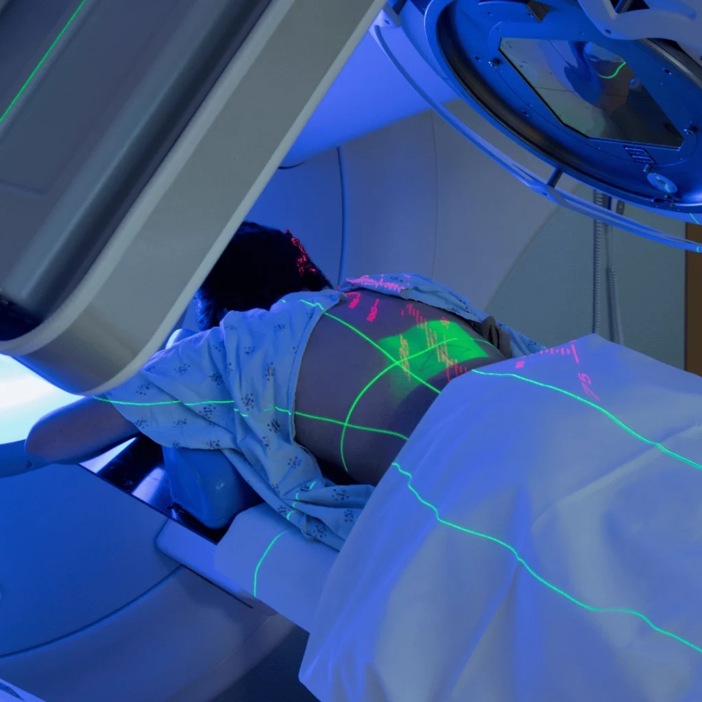 Stereotactic Body Radiation Therapy in Turkey: The SBRT Treatment Process