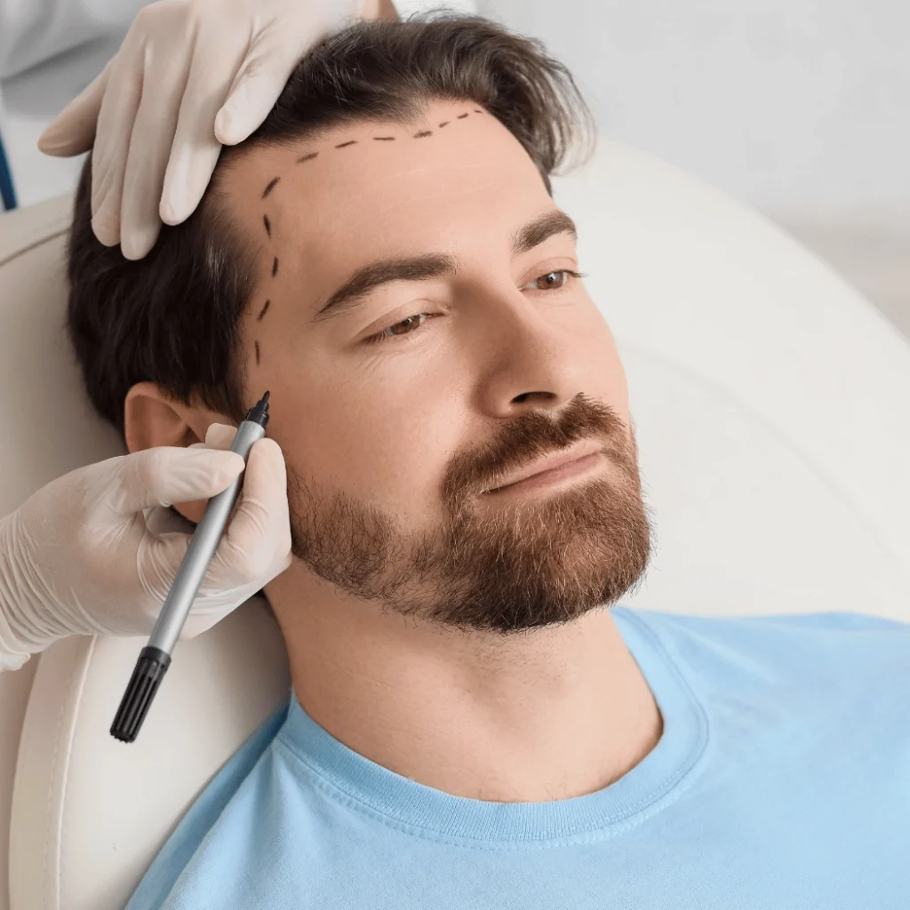 Transform Your Look with a Turkey Hair Transplant in Acibadem Hair Transplant Center