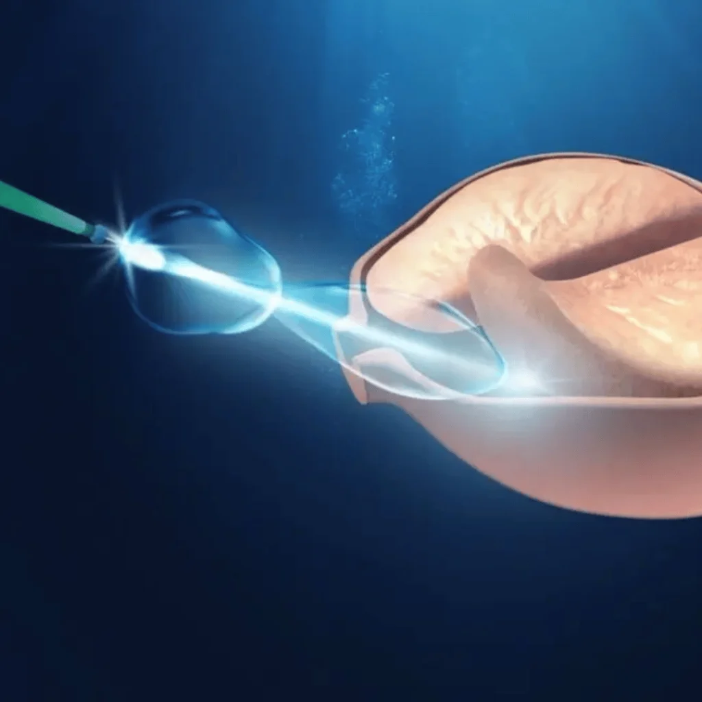 HoLEP Prostate Surgery: Why Laser Enucleation is Better Than TURP for Large Prostates
